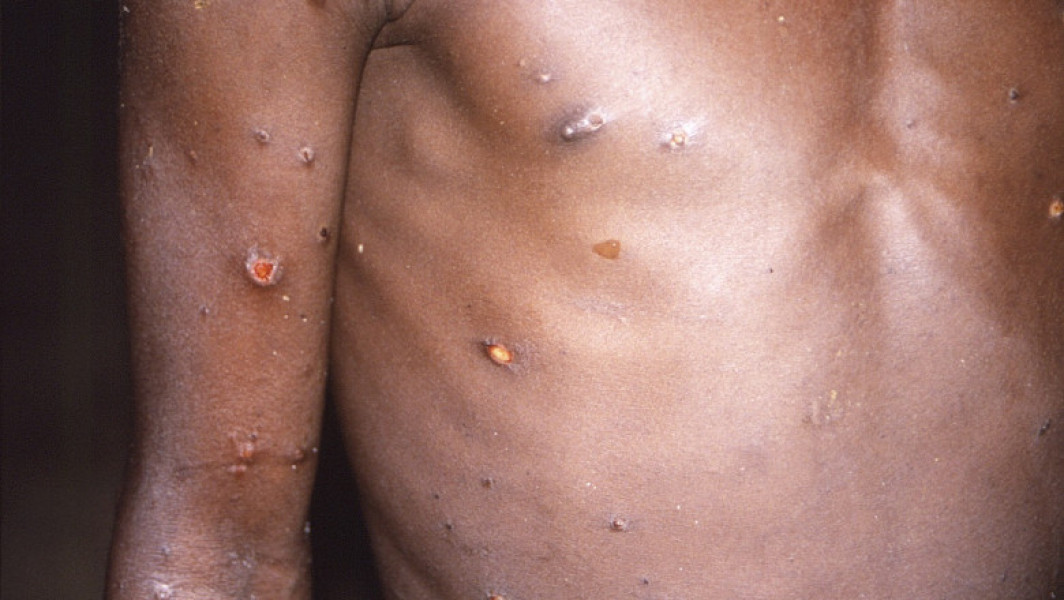 OMS a aprobat un vaccin pentru combaterea mpox. Comisia Europeană dă undă verde pentru vaccinarea adolescenților de 12 ani