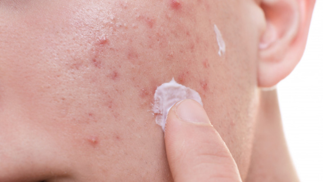 Substanță cancerigenă găsită în tratamentele pentru acnee ale unor mărci cunoscute"

"Descoperirea unei substanţe cancerigene în tratamentele împotriva acneei ale unor branduri populare