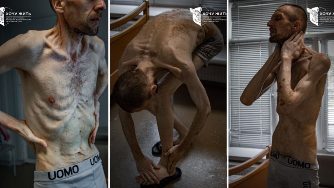 Foto Imagini șocante cu un prizonier ucrainean după doi ani de captivitate în Rusia. „Evocă cele mai întunecate pagini ale istoriei umane”